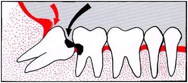 Wisdom Tooth